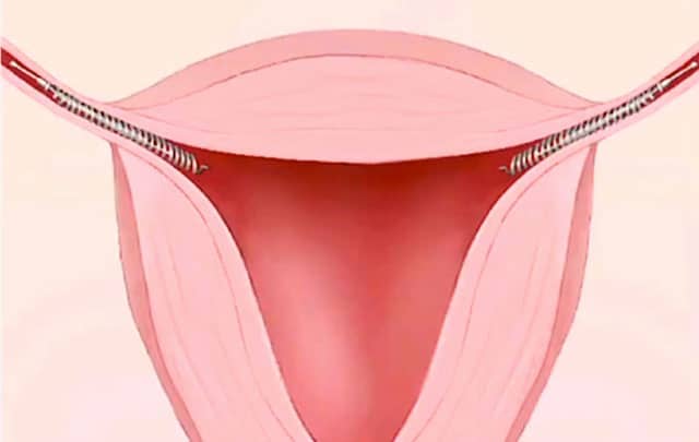 Essure Birth Control Device Implanted