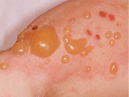 bullous pemphigoid blisters and skin rash
