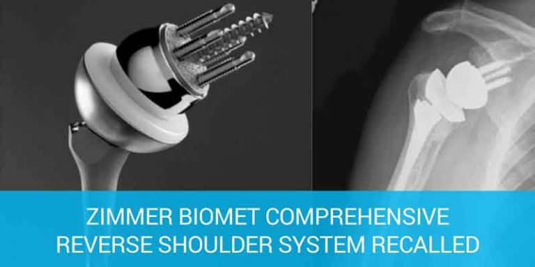 zimmer recalls reverse shoulder device