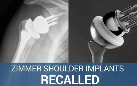 Zimmer Shoulder Implants FDA fast tracked after recall