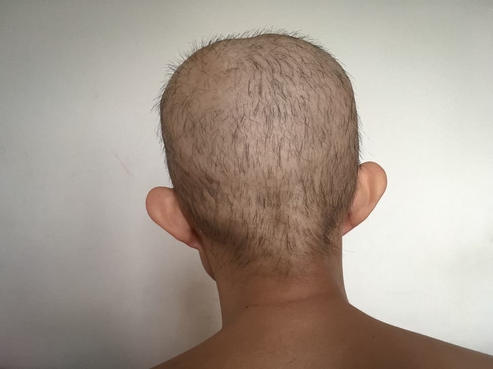 permanent hair loss from Taxotere