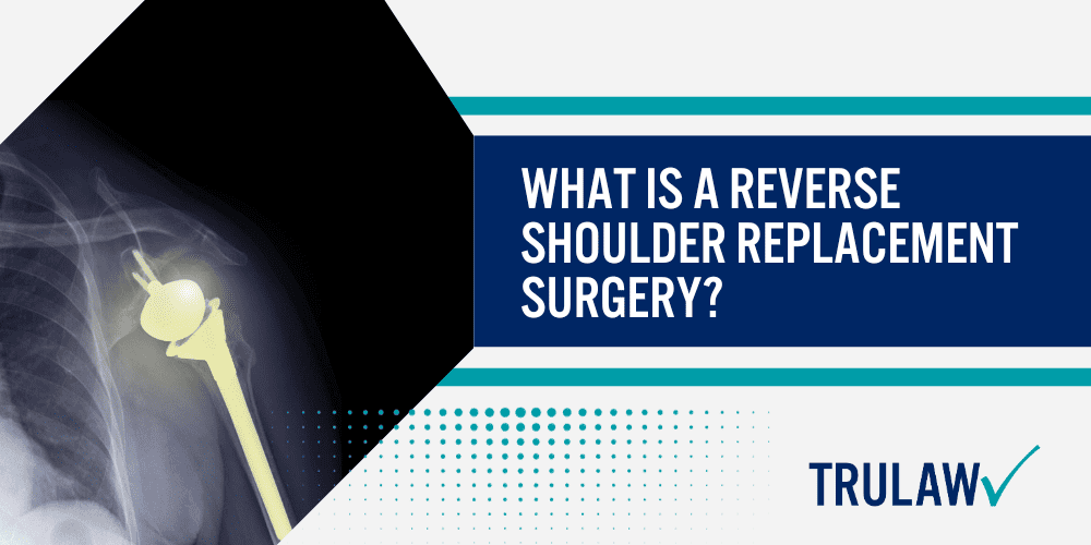 Zimmer Biomet Faulty Reverse Shoulder Implant Device; What Is A Reverse Shoulder Replacement Surgery