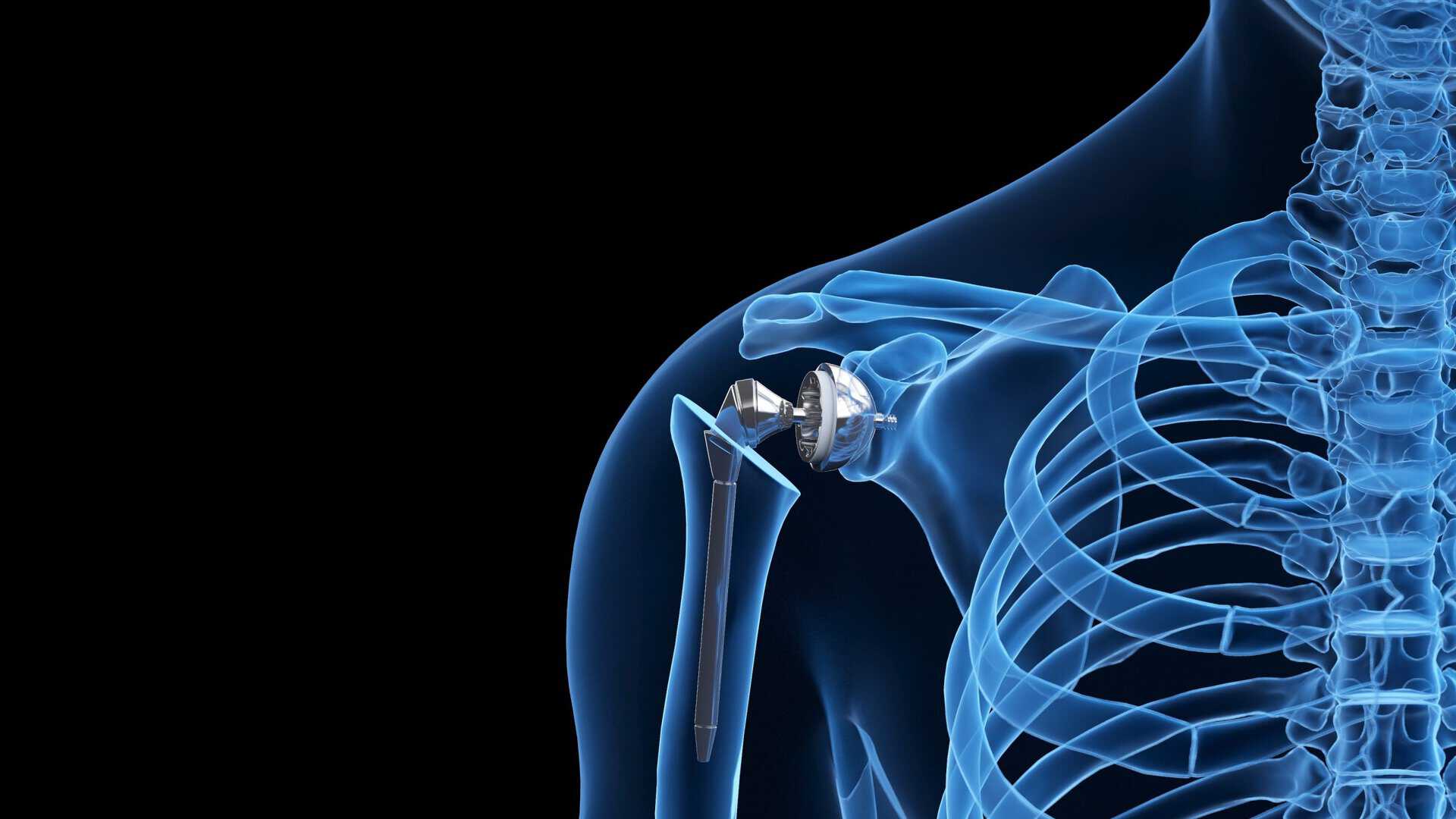 Zimmer-Biomet-Reverse-Shoulder-Lawsuits-Display-Image-scaled-1