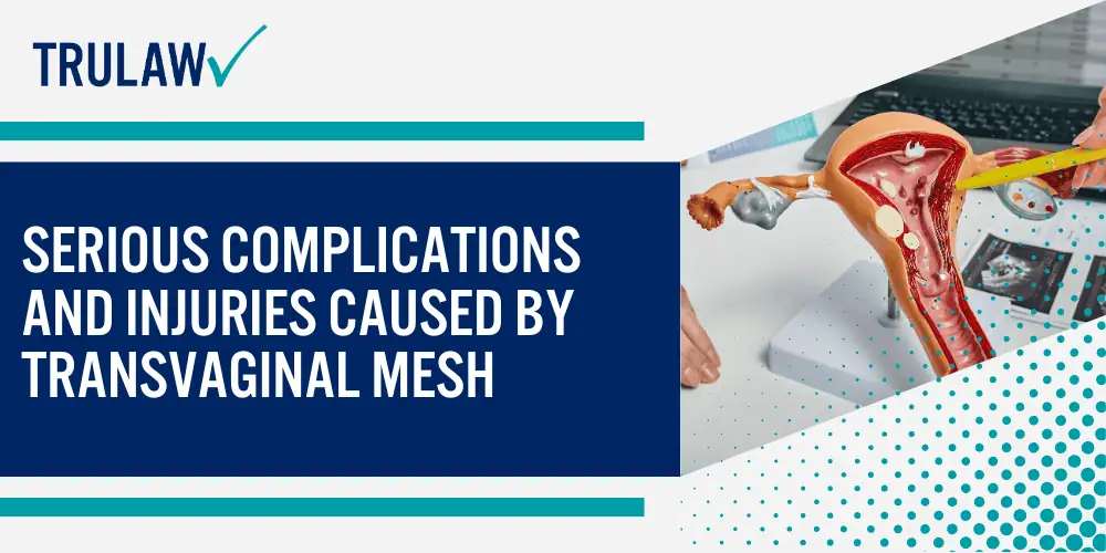 Why Are Women Filing Vaginal Mesh Claims; The Legal Basis for Transvaginal Mesh Claims; Serious Complications and Injuries Caused by Transvaginal Mesh