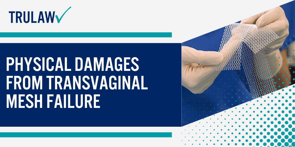 How Can A Transvaginal Mesh Attorney from TruLaw Help You; Physical Damages from Transvaginal Mesh Failure