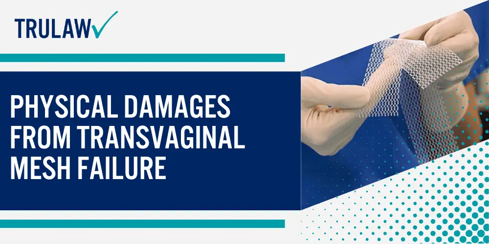 How Can A Transvaginal Mesh Attorney from TruLaw Help You; Physical Damages from Transvaginal Mesh Failure
