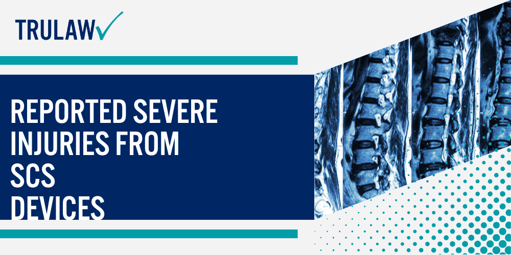 How Can A Spinal Cord Stimulator Attorney from TruLaw Help You; Reported Severe Injuries from SCS Devices