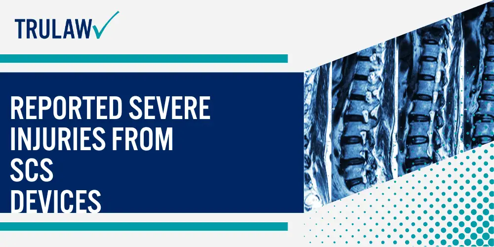 How Can A Spinal Cord Stimulator Attorney from TruLaw Help You; Reported Severe Injuries from SCS Devices