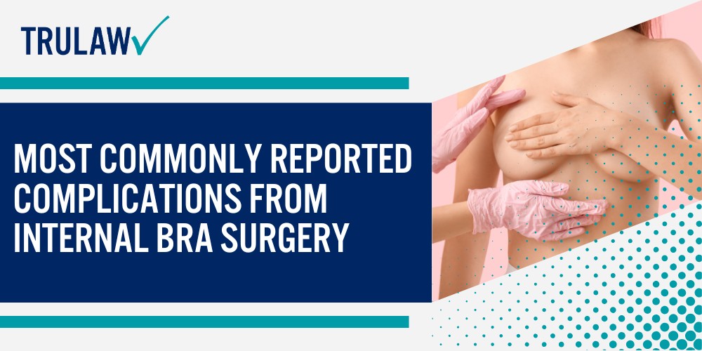 What Is the Internal Bra Technique and How Does It Work; Types of Biologic and Synthetic Meshes Used in Internal Bra Procedures; Why Breast Mesh Implants Are Used in Breast Augmentation and Reconstruction; FDA Warnings About Internal Bra Mesh Safety; November 2023 FDA Letter to Health Care Providers; Off-Label Marketing Concerns and Citizen Petitions; Most Commonly Reported Complications From Internal Bra Surgery